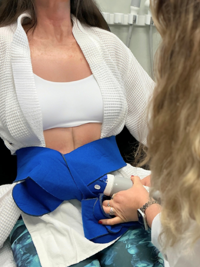 A CoolSculpting applicator strapped around a woman's abdomen