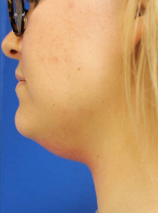 Before and after Kybella on the chin, side view: before