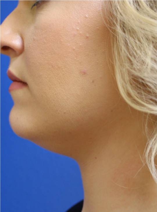 Before and after Kybella on the chin, side view: after