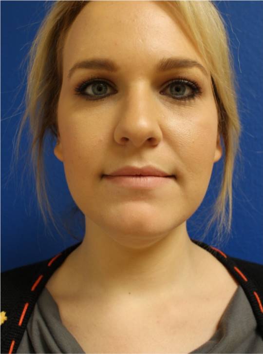 Before and after Kybella on the chin, front view: before