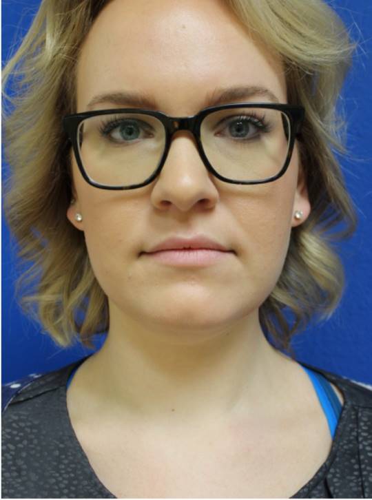 Before and after Kybella on the chin, front view: after
