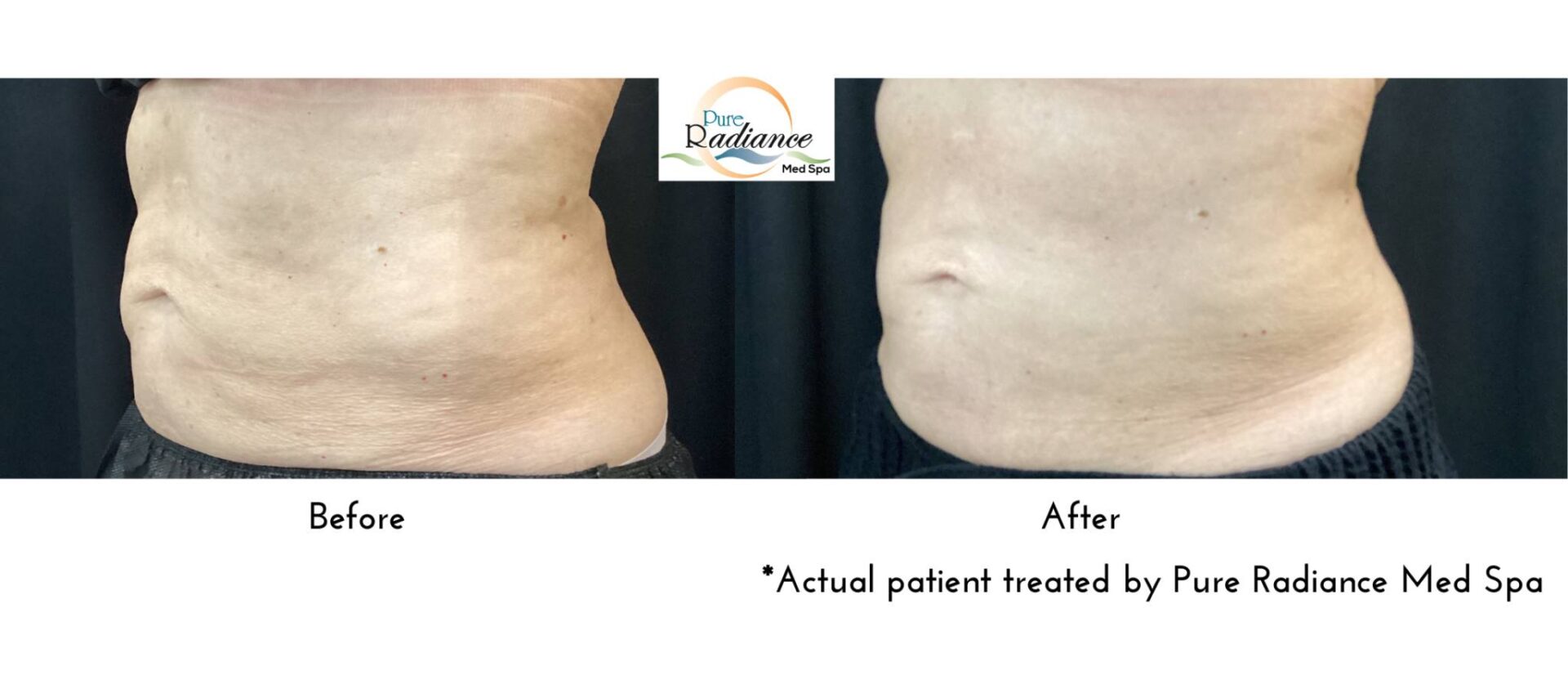 Before and after CoolTone on the abdomen, side by side