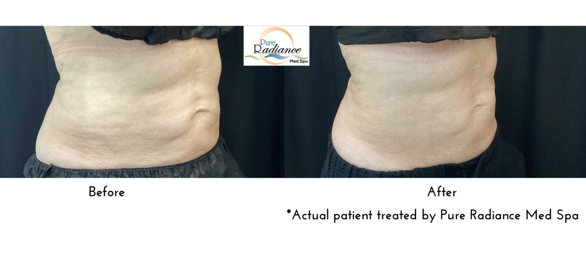 Before and after CoolTone on the abdomen, side by side