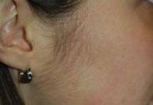 Before and after laser hair removal on the neck: before