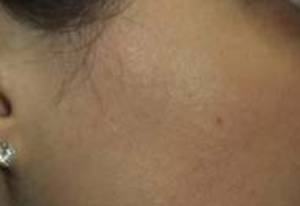 Before and after laser hair removal on the neck: after