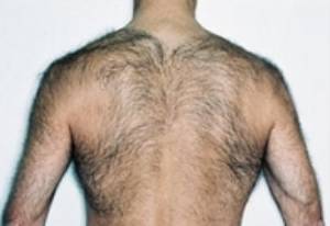 Before and after laser hair removal on the back: before