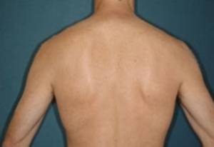 Before and after laser hair removal on the back: after