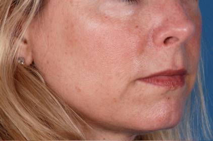 Before and after ZO Skin Health skin care on the face: before