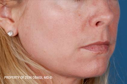 Before and after ZO Skin Health skin care on the face: after