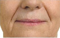 Before and after Radiesse on the smile lines: before
