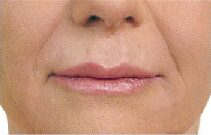 Before and after Radiesse on the smile lines: after