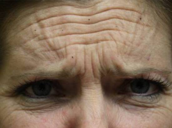 Before and after Botox® on forehead lines: before