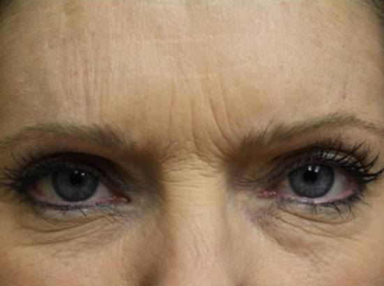 Before and after Botox® on forehead lines: after