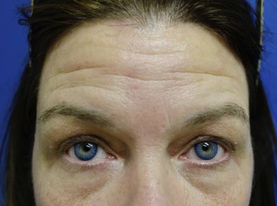 Before and after Botox® on forehead lines: before