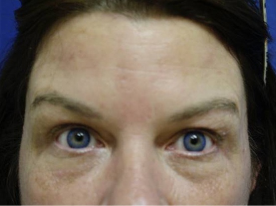 Before and after Botox® on forehead lines: after