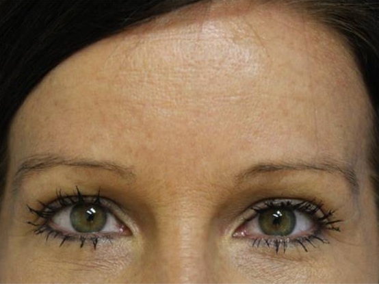 Before and after Botox® on forehead lines: before