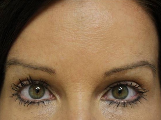 Before and after Botox® on forehead lines: after