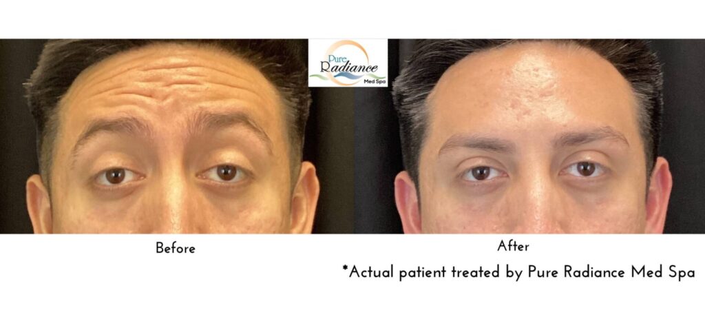 Before and after Dysport on forehead lines, side by side