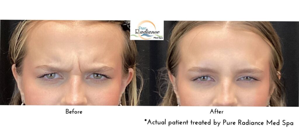 Before and after Dysport on forehead lines, side by side