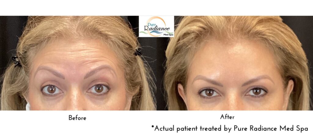 Before and after Dysport on forehead lines, side by side