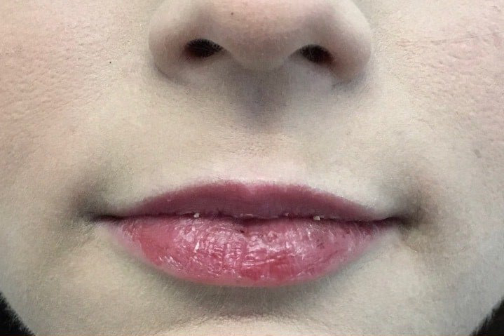 Before and after lip filler: before