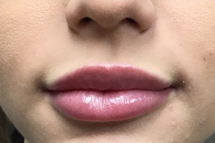 Before and after lip filler: after