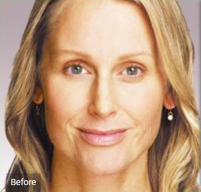 Before and after dermal filler on the face: before