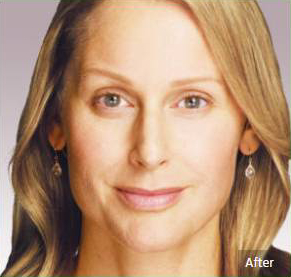 Before and after dermal filler on the face: after