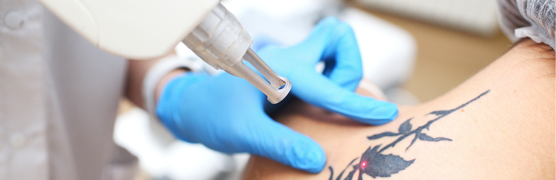 A provider in blue gloves using a laser handpiece on a rose tattoo