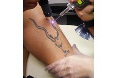 tattoo-removal-nav