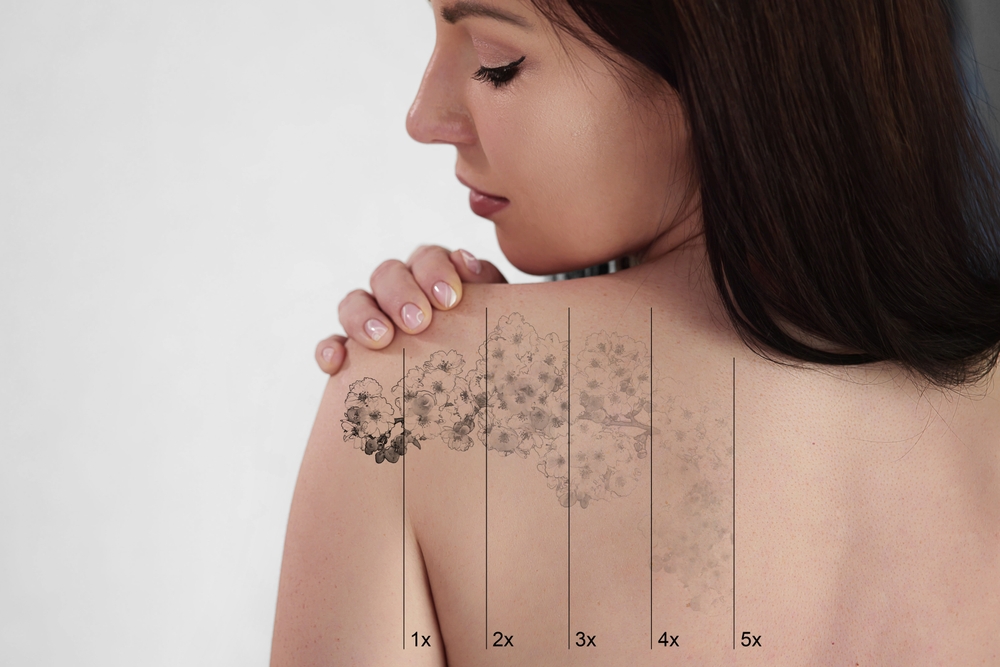 Woman glances at her back tattoo that is removed over multiple laser sessions. Woman glances at her back tattoo that is removed over multiple laser sessions.
